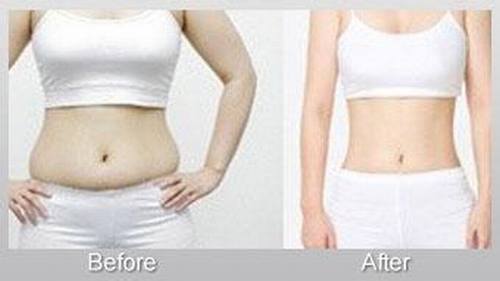 做腰部吸脂会不会反弹呢?