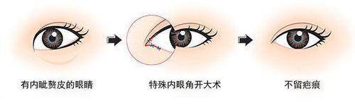 开眼角手术都有哪些方法呢