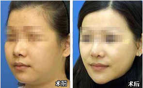 通过双下巴吸脂能瘦脸果吗