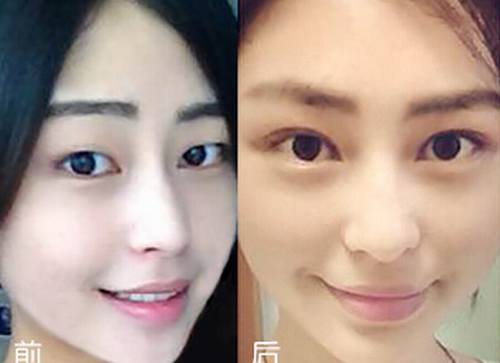 开眼角的价格贵吗?