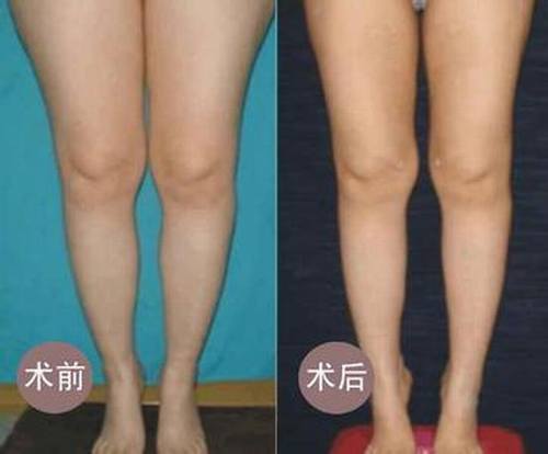 腿部吸脂手术价格是多少?