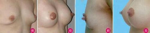 自体脂肪丰胸好吗?