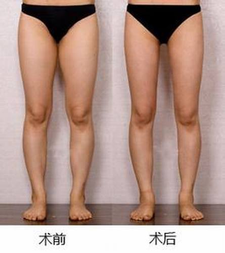 腿部吸脂的价格贵不贵?