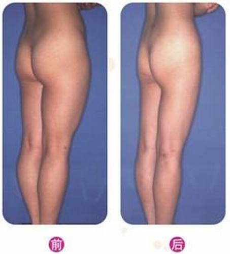 大腿吸脂后皮肤会松弛吗?