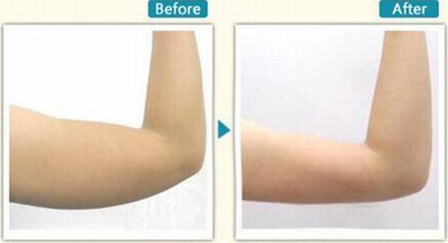 手臂吸脂的果好吗?