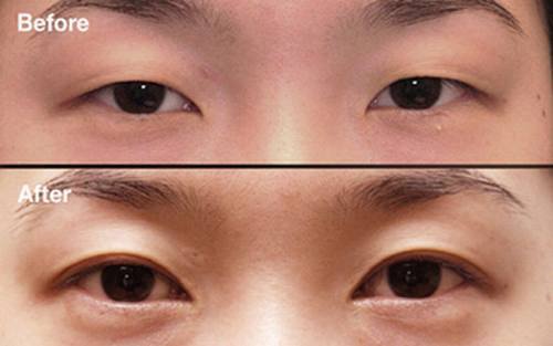 双眼皮手术有什么危险吗?