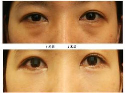 如何消除黑眼圈较有呢?