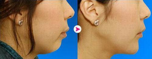 玻尿酸隆下巴需要多少钱呢?