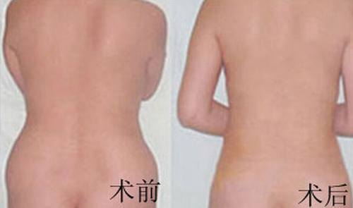 吸脂减肥的优势有哪些呢?