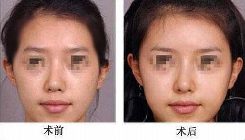 丰太阳穴后需要注意什么呢?