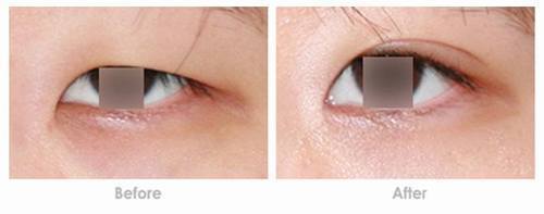 上睑下垂矫正需要多少钱呢?