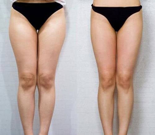 大腿吸脂减肥有副作用吗?