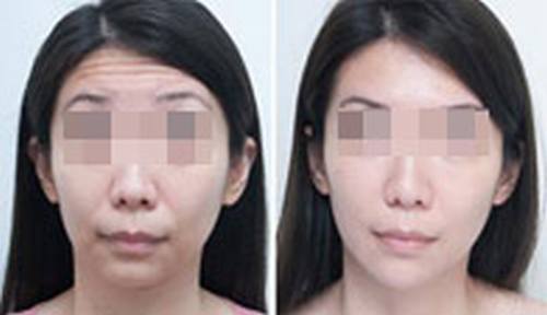 VISIA皮肤检测仪