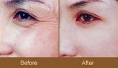 C6激光-终结各种斑点的祛斑神话