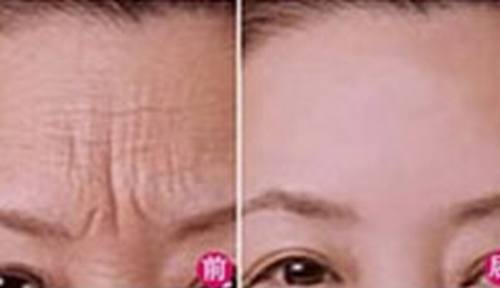 辉煌TM激光360嫩肤系统