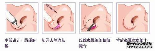 鼻翼整形1.jpg