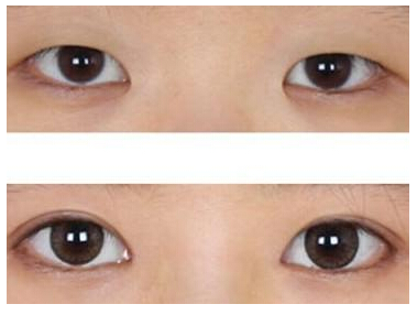 眼睛太小可以变大吗