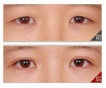 水泡眼该怎么治