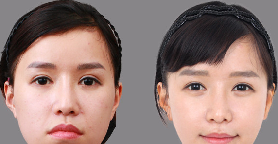 卧蚕再造的方法有哪些