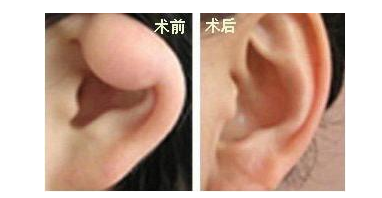 切除附耳会留疤吗