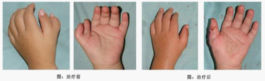 新生儿出现多指应该怎么办