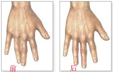 新生儿出现并指该怎么治疗