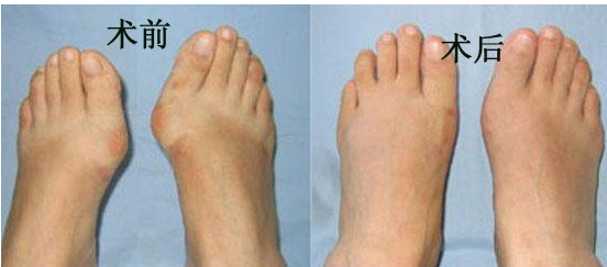 出现大脚骨该怎么治疗