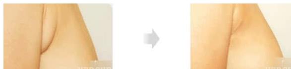 女性出现副乳该怎么办