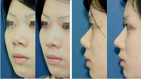 出现朝天鼻该怎么矫正