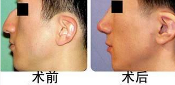 鹰钩鼻还能进行校正吗