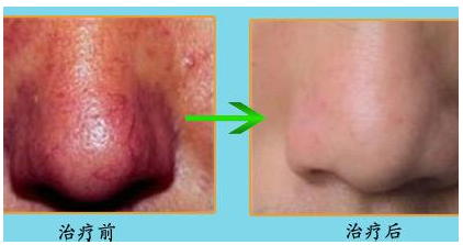 出现酒糟鼻该怎么办