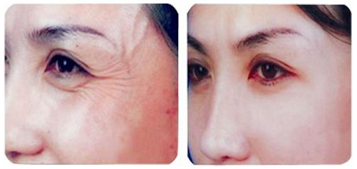 去鱼尾纹的方法有哪些