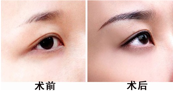 通过激光洗眉会不会留疤