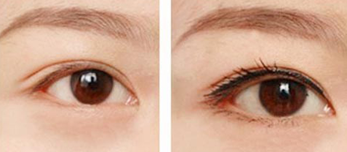 通过激光洗眼线痛吗