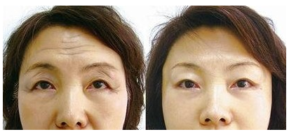 激光去抬头纹的果怎么样