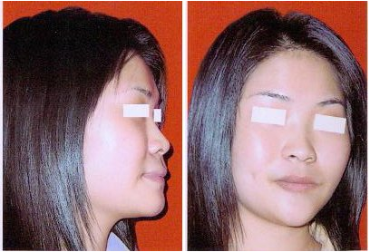 酒窝成形术后多久才能恢复