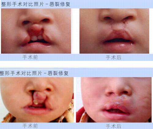 兔唇应该怎么修复