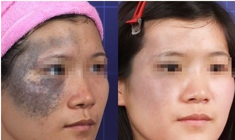 激光去太田痣会复发吗