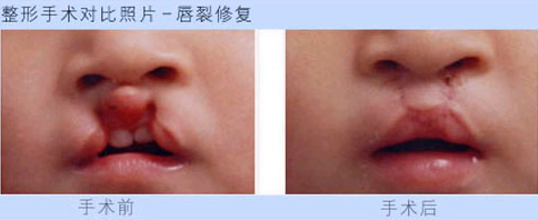 兔唇修复术后该怎么护理