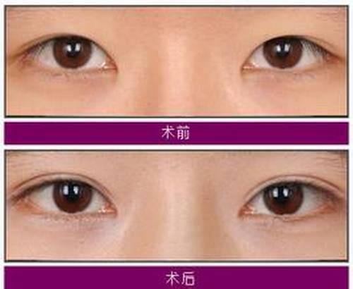 双眼皮手术贵不贵呢?