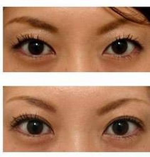 双眼皮失败的修复方法有哪些?