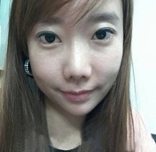 术后一个月，果很好